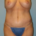 Patient 4 After Abdominoplasty Front View