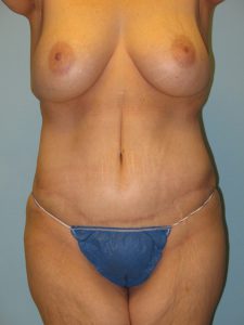 Patient 4 After Abdominoplasty Front View