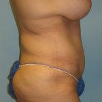 Patient 4 After Abdominoplasty Right Side View