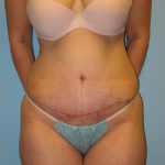 Patient 5 After Abdominoplasty Front View