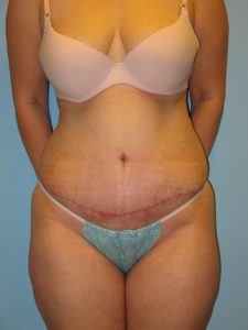 Patient 5 After Abdominoplasty Front View
