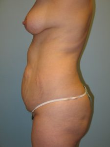 Patient 5 Before Abdominoplasty Left Side View
