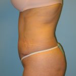 Patient 5 After Abdominoplasty Left Side View