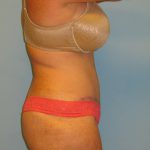 Patient 6 After Abdominoplasty Right Side View