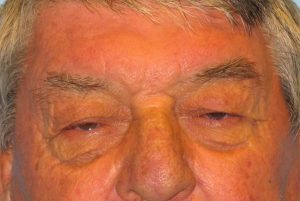 Patient 10 Before Blepharoplasty