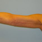 Patient 1 After Brachioplasty Right Arm