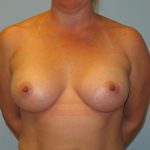 Patient 5 After Breast Augmentation Front View