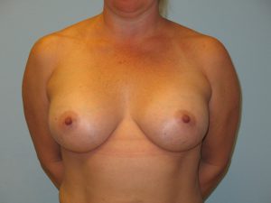 Patient 5 After Breast Augmentation Front View