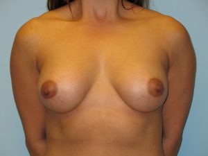 Patient 6 After Breast Augmentation Front View