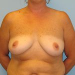 Patient 7 Before Breast Augmentation Front View