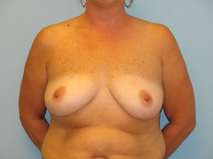 Patient 7 Before Breast Augmentation Front View