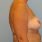Patient 7 Before Breast Augmentation Right View