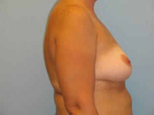 Patient 7 Before Breast Augmentation Right View