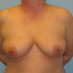 Patient 1 Before Breast Augmentation Front View