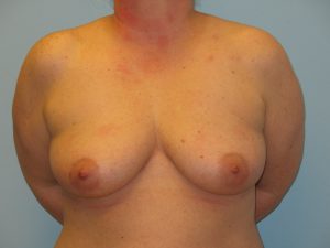 Patient 1 Before Breast Augmentation Front View