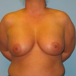 Patient 1 After Breast Augmentation Front View