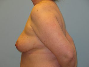 Patient 1 Before Breast Augmentation Left View