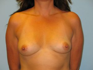 Patient 3 Before Breast Augmentation Front View
