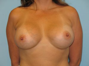 Patient 3 After Breast Augmentation Front View