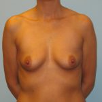 Patient 4 Before Breast Augmentation Front View