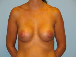 Patient 4 After Breast Augmentation Front View