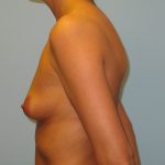 Patient 4 Before Breast Augmentation Left View
