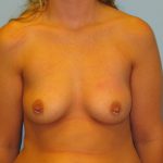 Patient 13 Before Breast Augmentation Front View