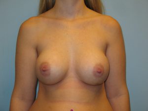 Patient 13 After Breast Augmentation Front View