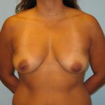 Patient 9 Before Breast Augmentation Front View