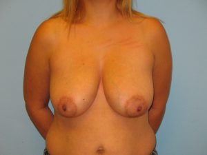 Patient 1 Before Breast Reduction Front View