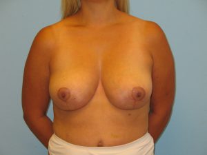Patient 1 After Breast Reduction Front View