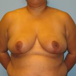 Patient 10 After Breast Reduction Front View