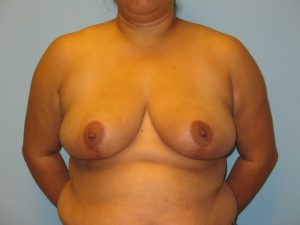 Patient 10 After Breast Reduction Front View