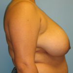 Breast Reduction The Woodlands Patient 10