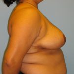 Patient 10 After Breast Reduction Right View