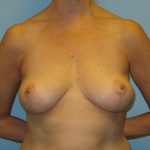 Patient 12 After Breast Reduction Front View