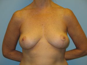 Patient 12 After Breast Reduction Front View