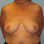 Patient 13 After Breast Reduction Front View