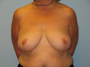 Patient 13 After Breast Reduction Front View