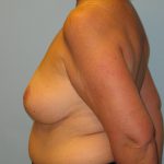 Patient 13 After Breast Reduction Left View