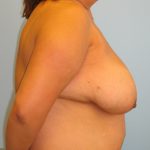 Patient 14 Before Breast Reduction Right View