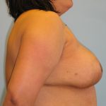 Patient 14 After Breast Reduction Right View
