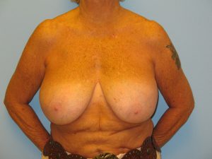 Patient 15 Before Breast Reduction Front View