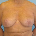 Patient 15 After Breast Reduction Front View