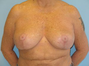 Patient 15 After Breast Reduction Front View