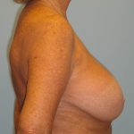 Patient 15 Before Breast Reduction Right View
