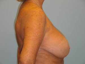 Patient 15 Before Breast Reduction Right View