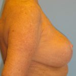 Patient 15 After Breast Reduction Right View