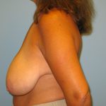 Patient 16 Before Breast Reduction Left View