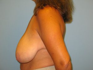 Patient 16 Before Breast Reduction Left View